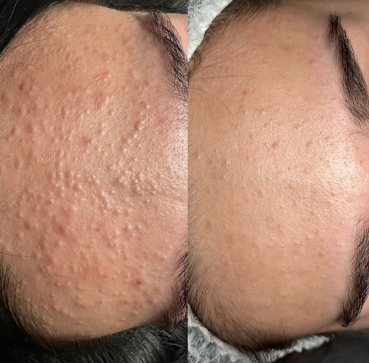 Curso online de Peeling Natural