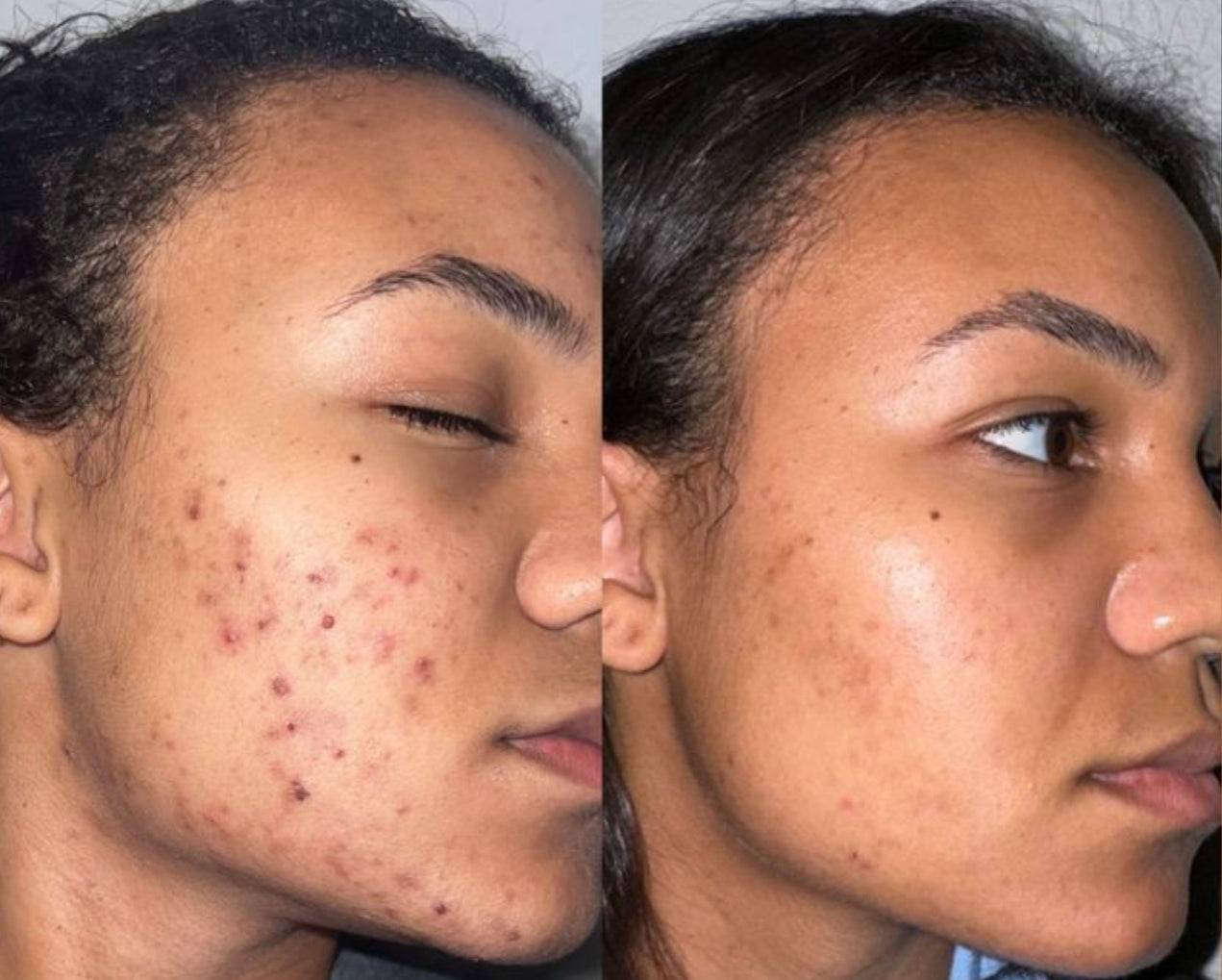 Crema hidratante para piel con tendencia al acné