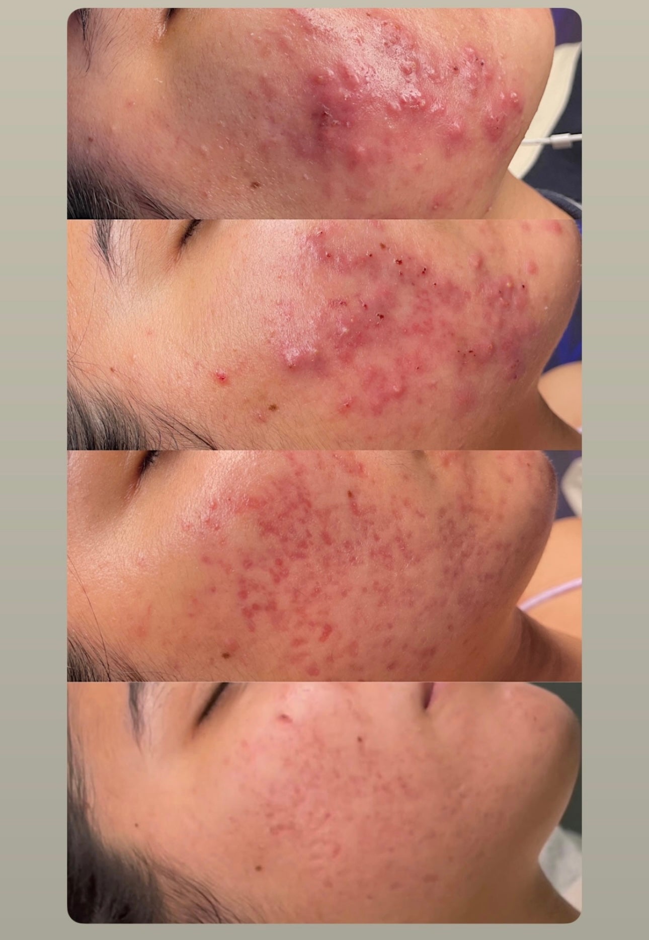 Curso online de Peeling Natural