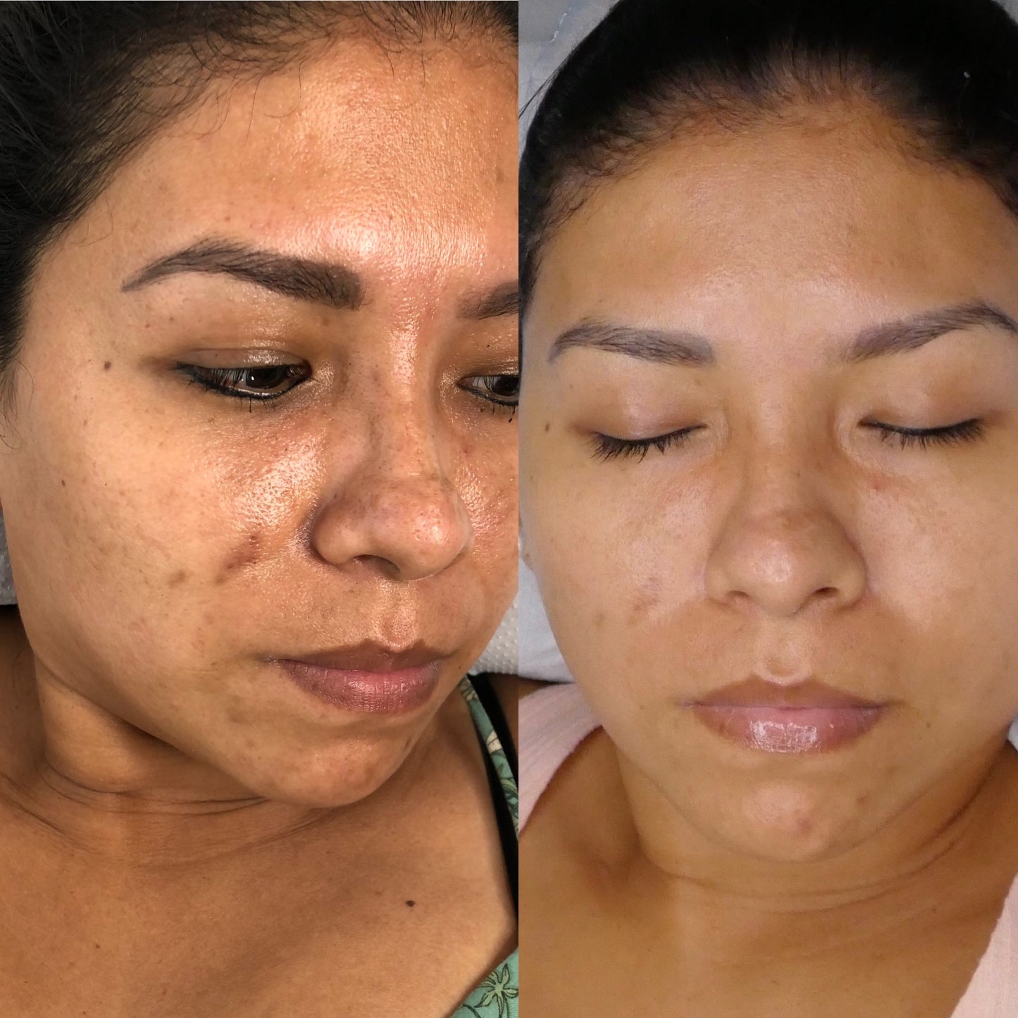 Curso Presencial Dermapen + PDF+ Acceso a comunidad de alumnas