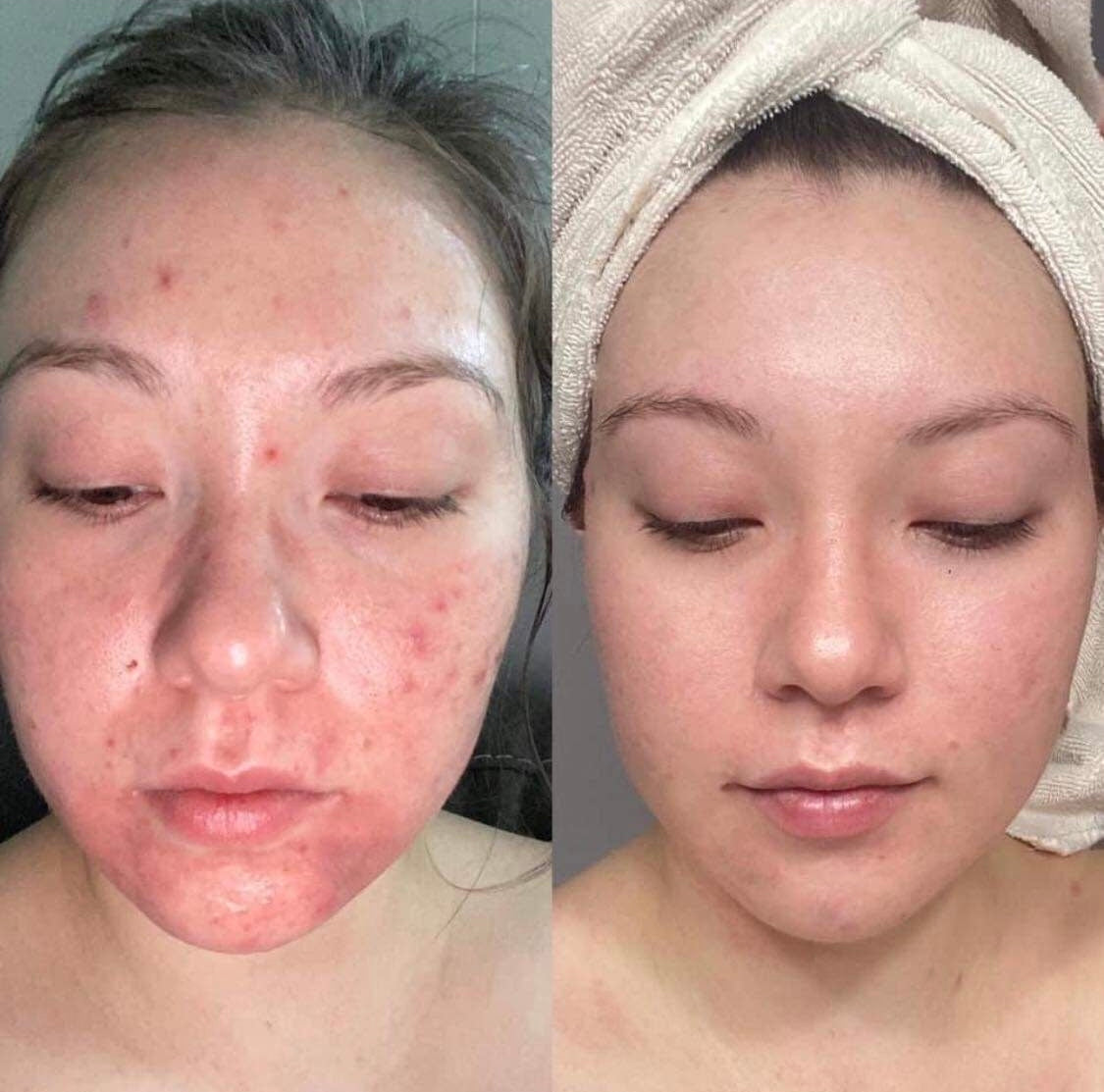 Curso online de Peeling Natural