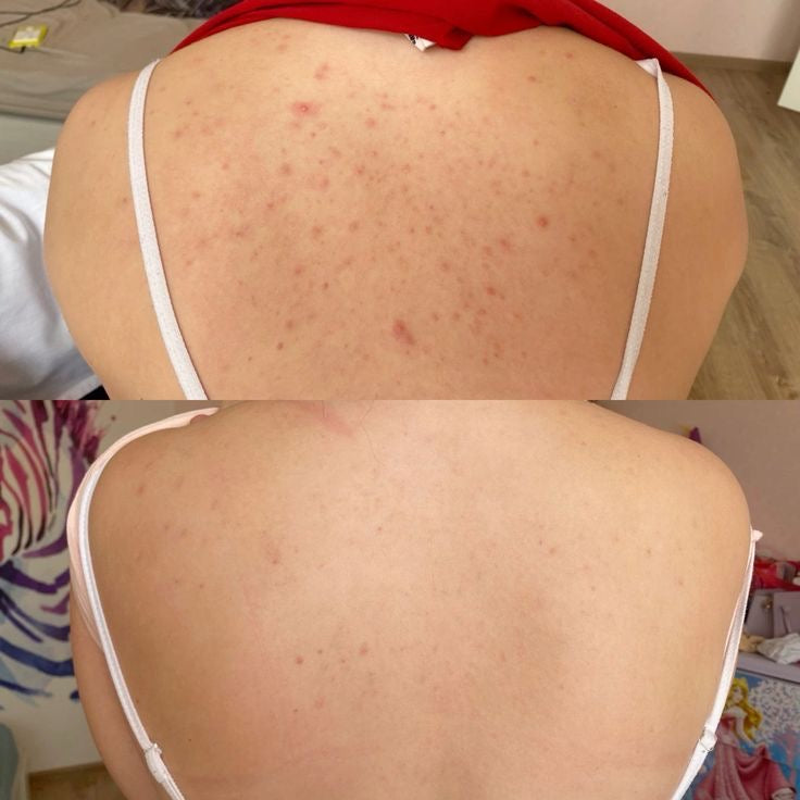 Curso online de Peeling Natural