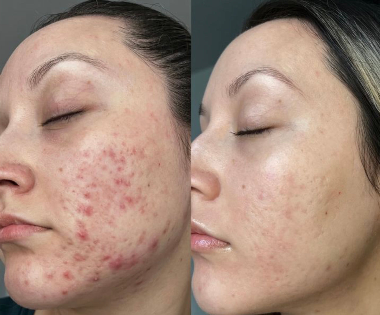 Crema hidratante para piel con tendencia al acné