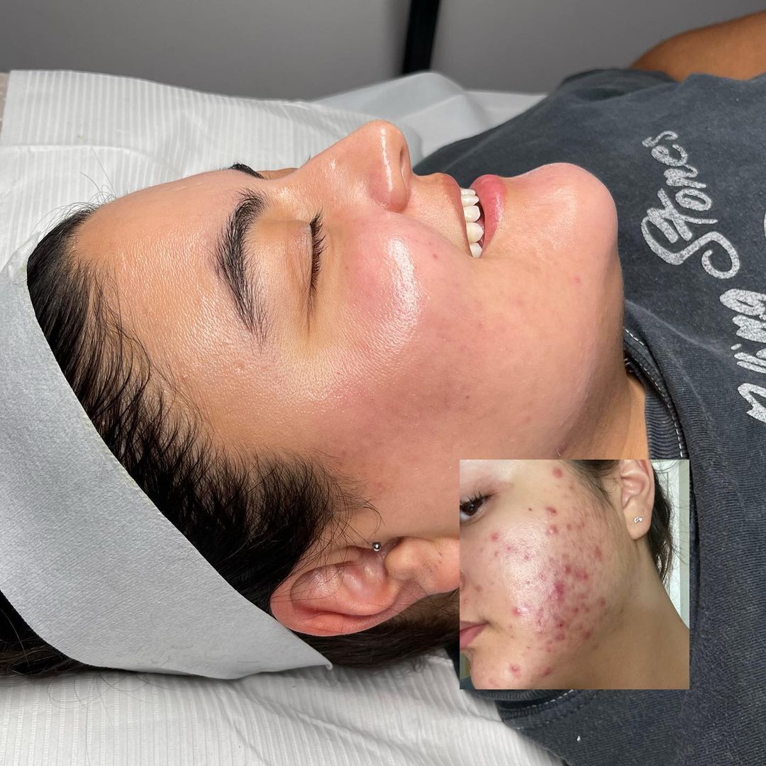 Curso online Dermapen + PDF+ Acceso a comunidad de alumnas