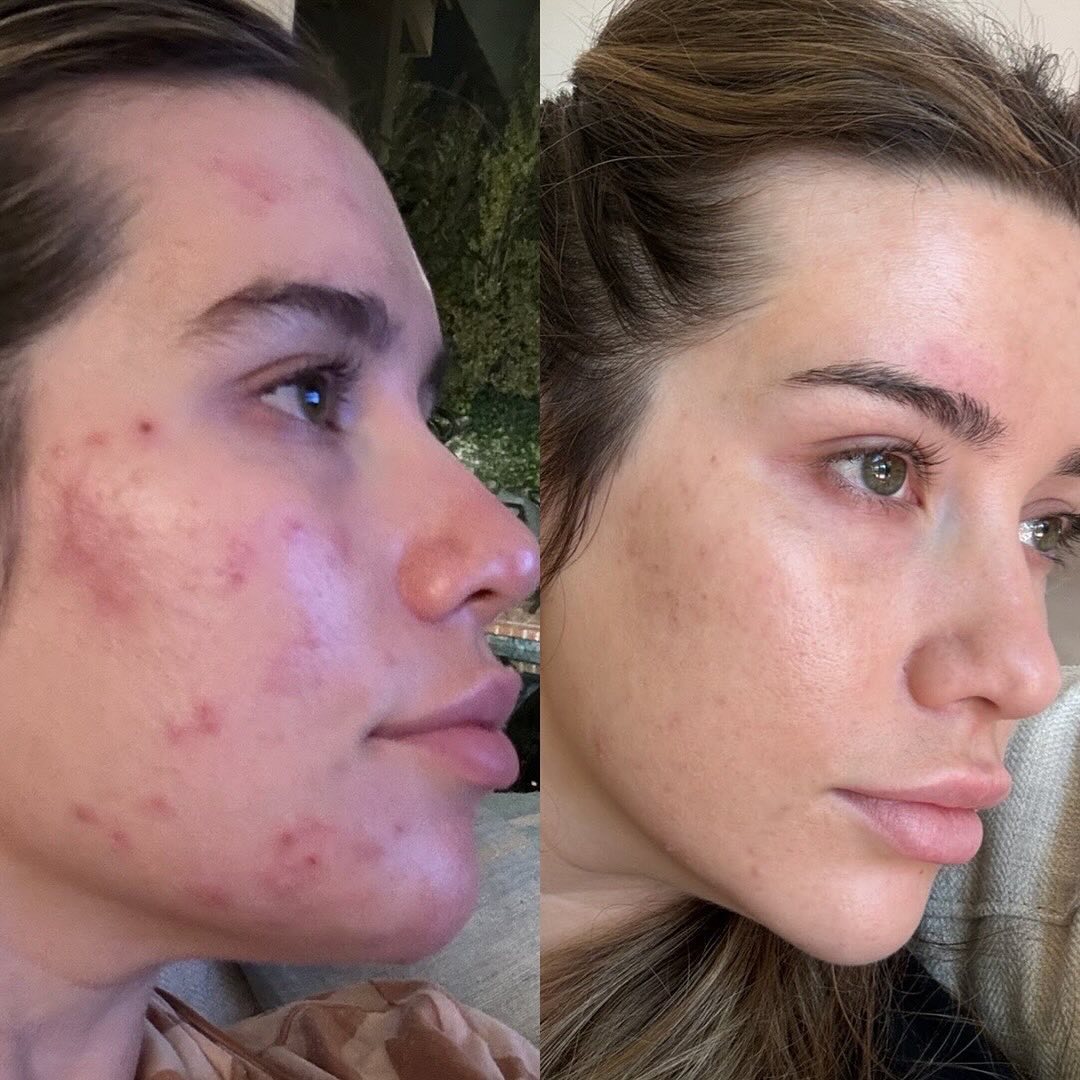 Crema hidratante para piel con tendencia al acné