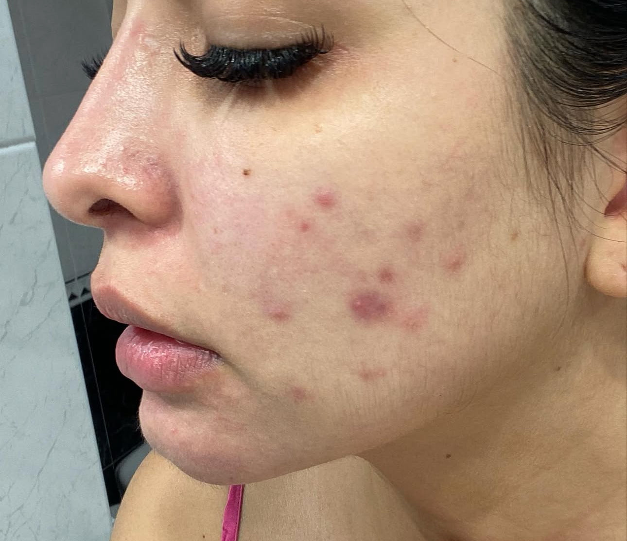 Crema hidratante para piel con tendencia al acné