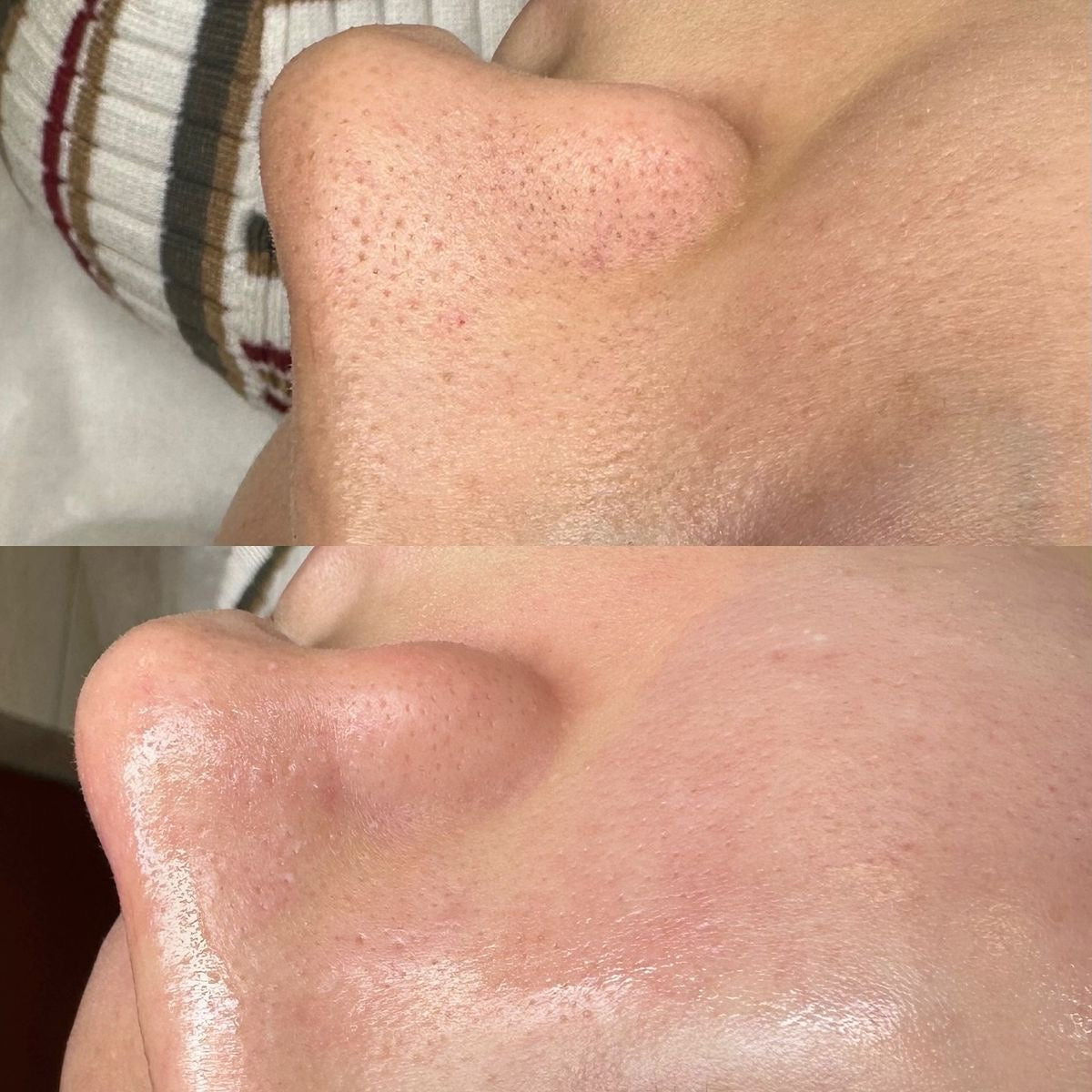 HIGIENE FACIAL PROFUNDA + RUTINA PERSONALIZADA