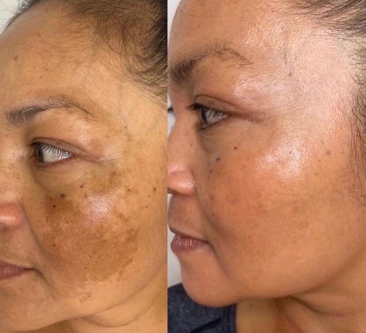 Ampolla para manchas