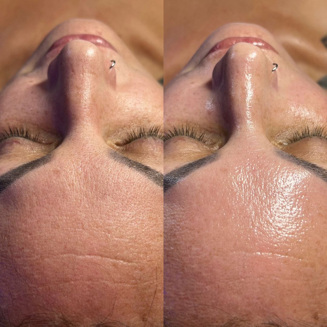 Curso Presencial  Dermapen + PDF+ Acceso a comunidad de alumnas
