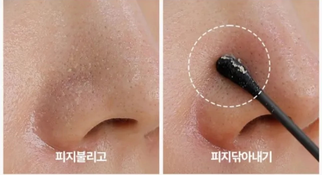 Adiós Puntos Negros - Tratamiento Coreano