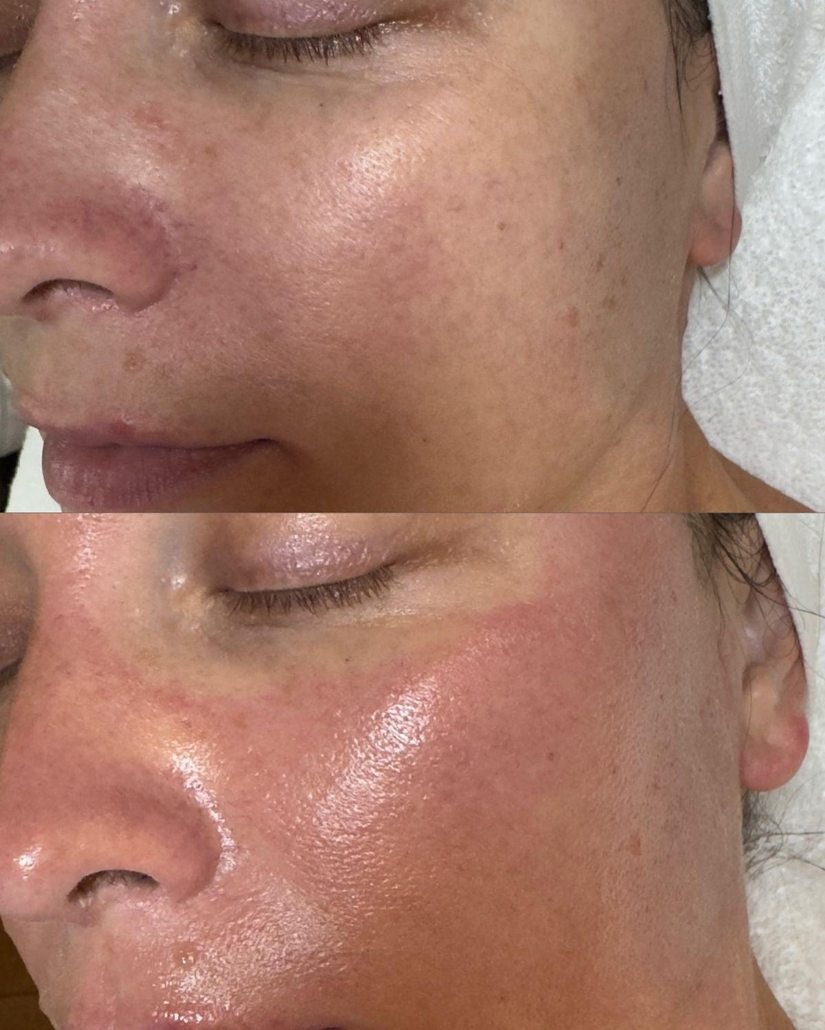 Curso Presencial  Dermapen + PDF+ Acceso a comunidad de alumnas