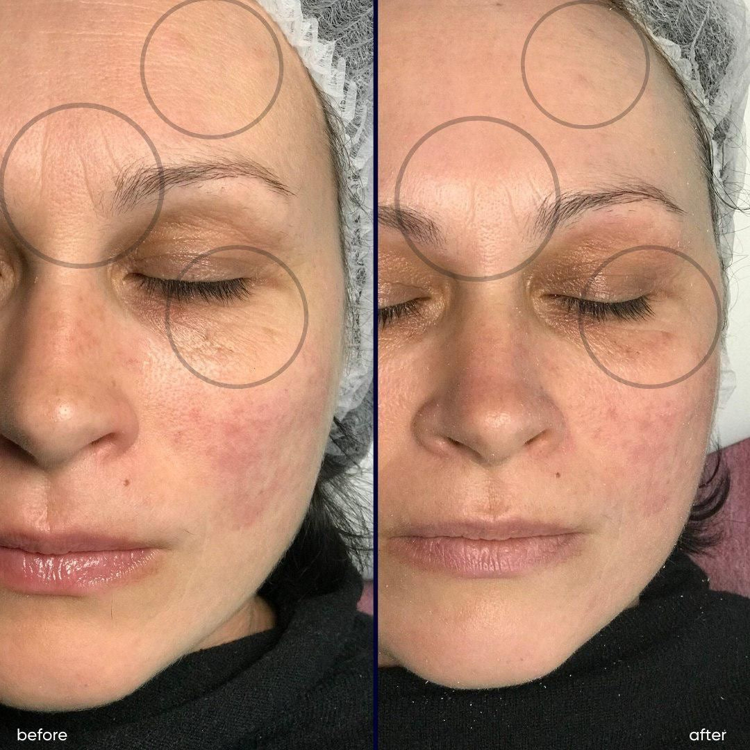 Curso Presencial  Dermapen + PDF+ Acceso a comunidad de alumnas