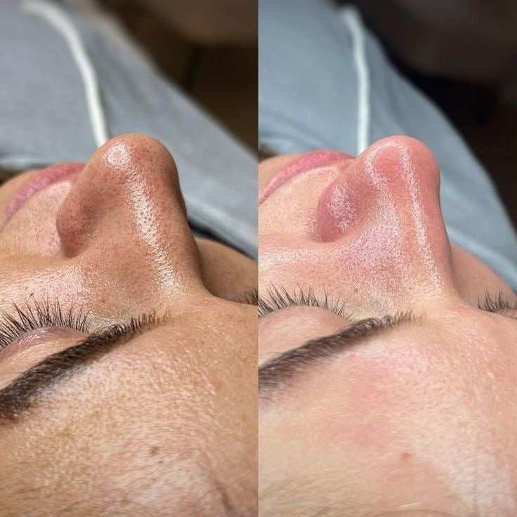 Ampollas  de inicio para dermapen