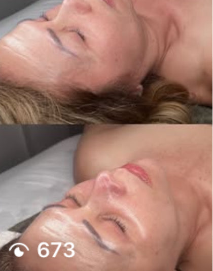 Ampollas  de inicio para dermapen