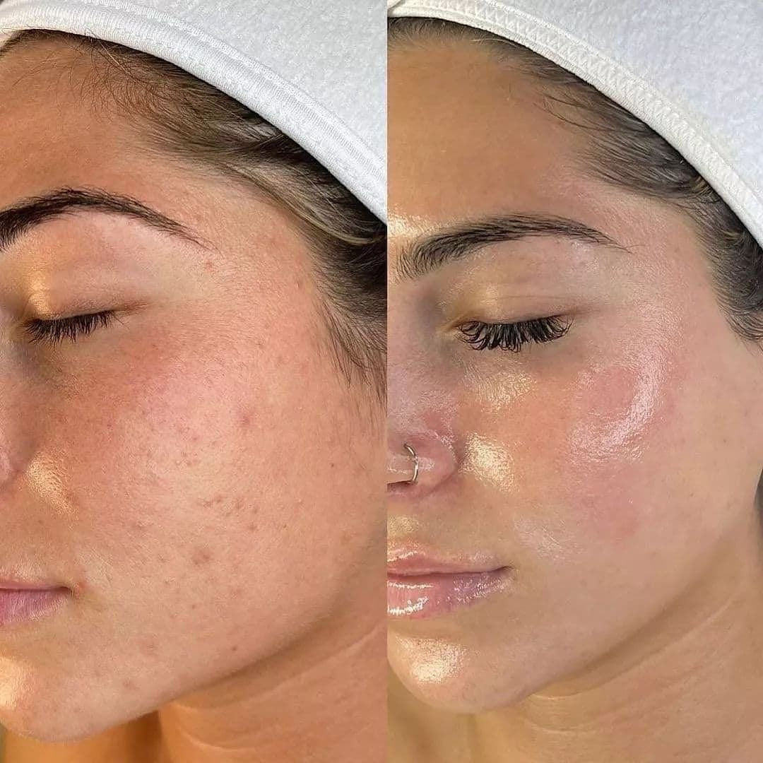 Curso Presencial  Dermapen + PDF+ Acceso a comunidad de alumnas