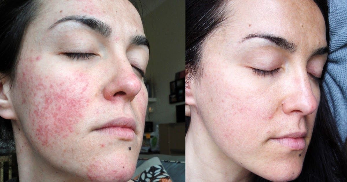 Kit Profesional Peeling Natural+ Curso online+ PDF