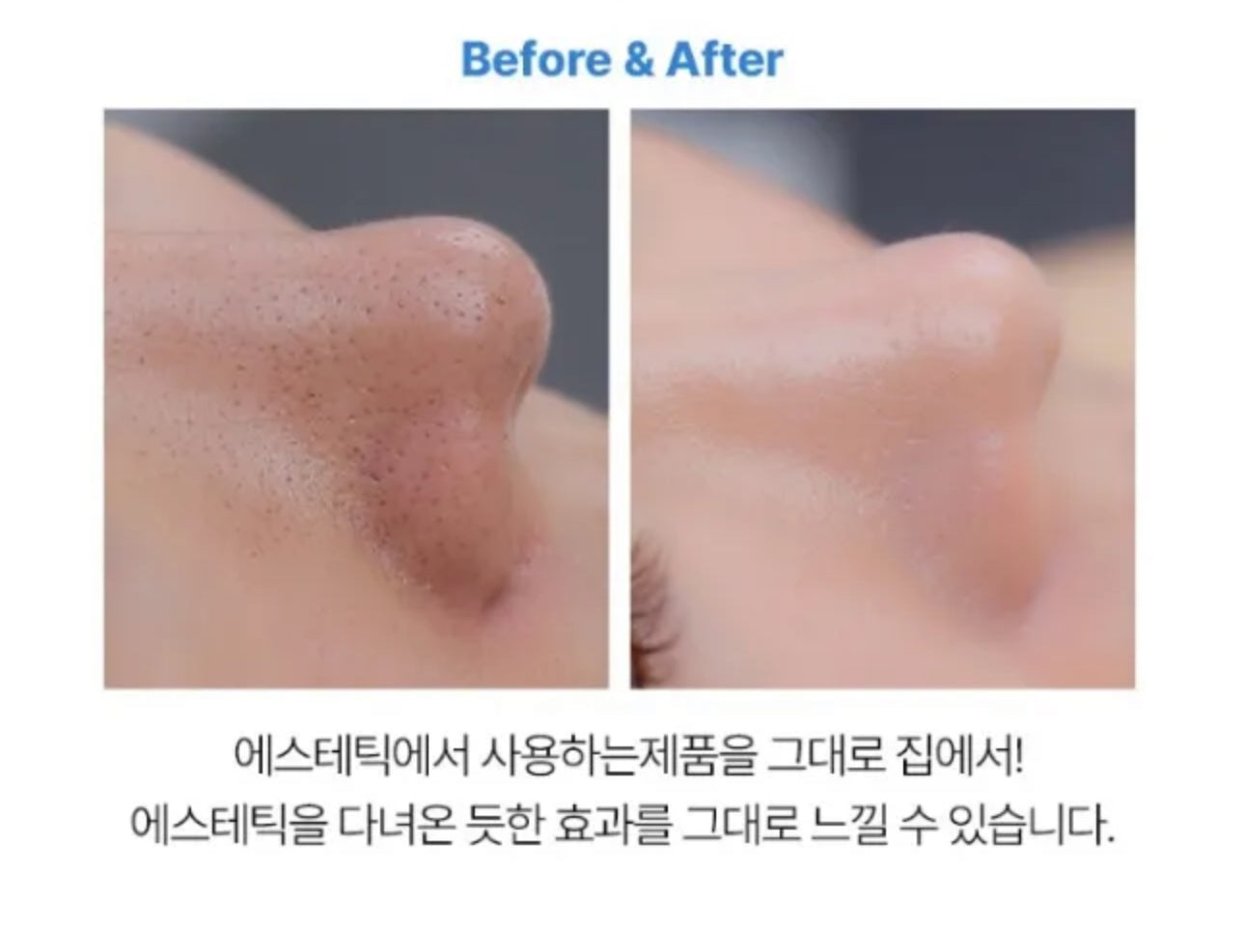 Adiós Puntos Negros - Tratamiento Coreano