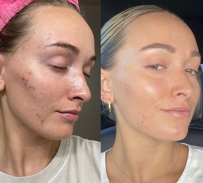 Ampolla para manchas