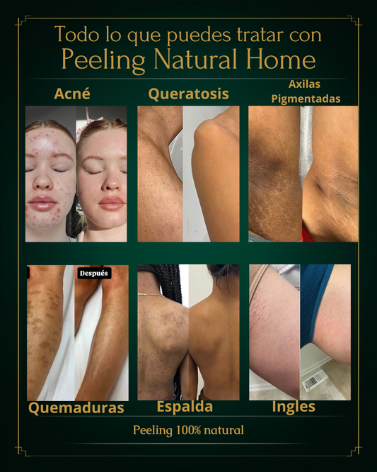 Peeling Home