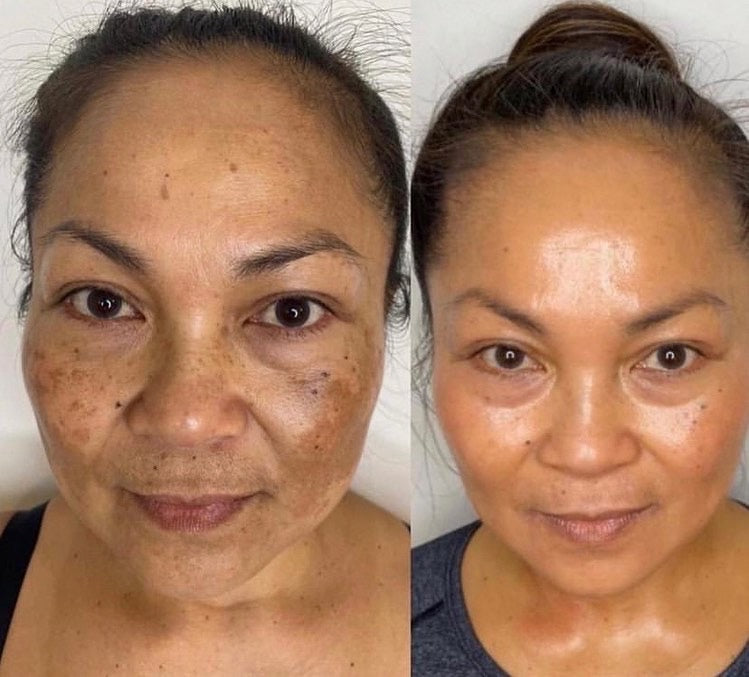 Ampolla para manchas