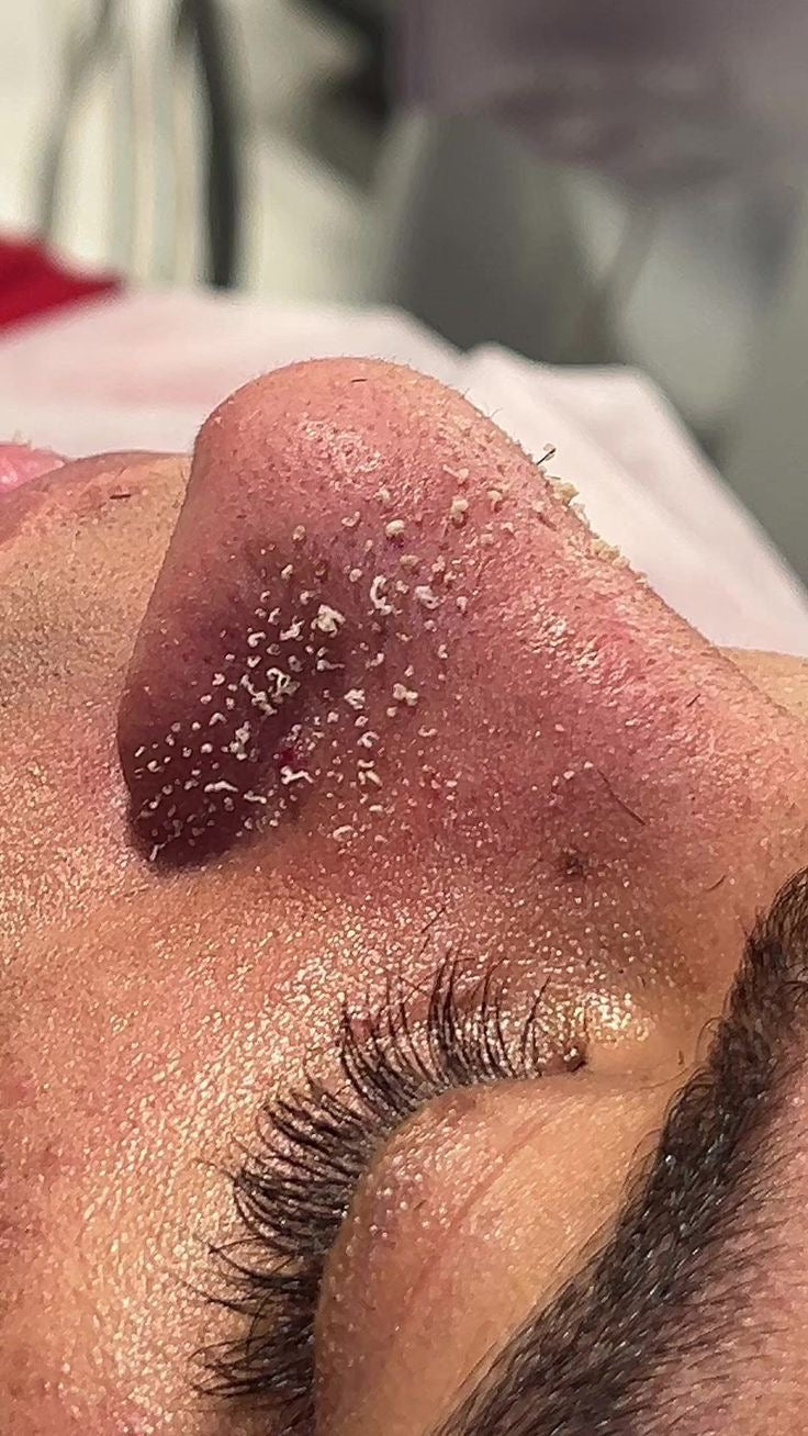 Adiós Puntos Negros - Tratamiento Coreano