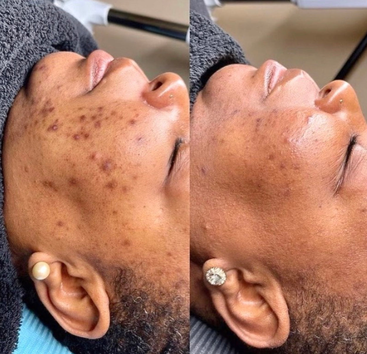 Ampolla para manchas