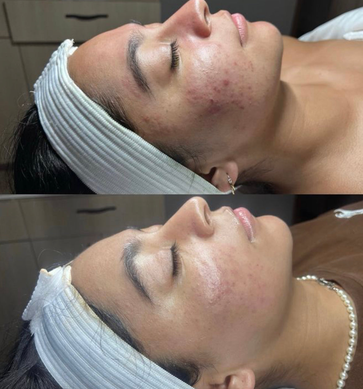 Curso Presencial  Dermapen + PDF+ Acceso a comunidad de alumnas