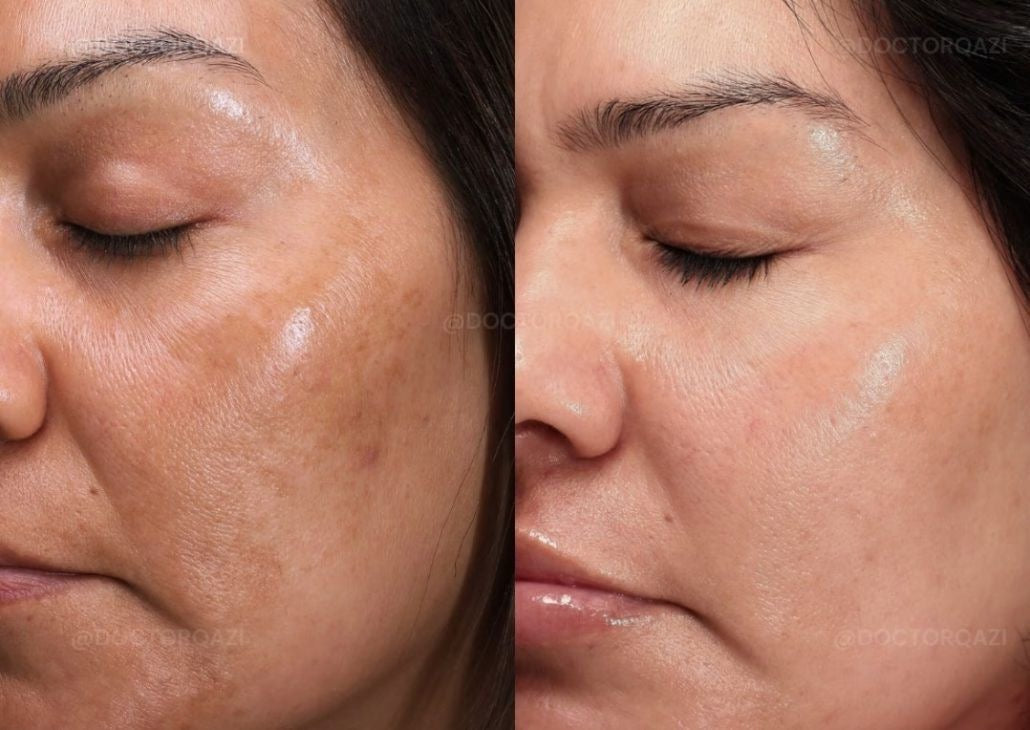 Curso Presencial  Dermapen + PDF+ Acceso a comunidad de alumnas