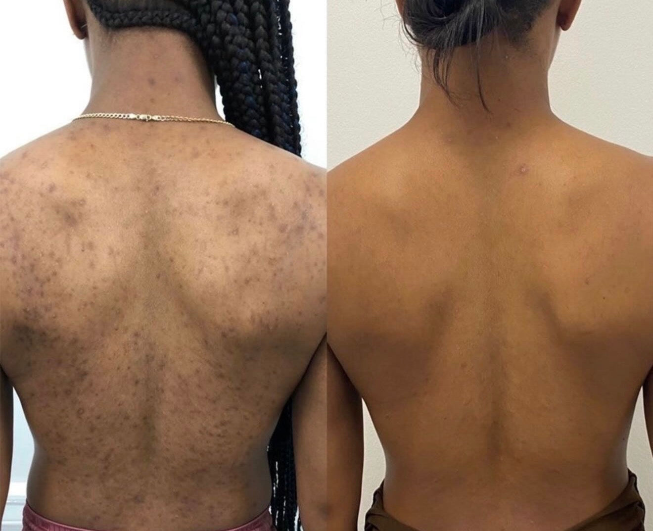Peeling Natural