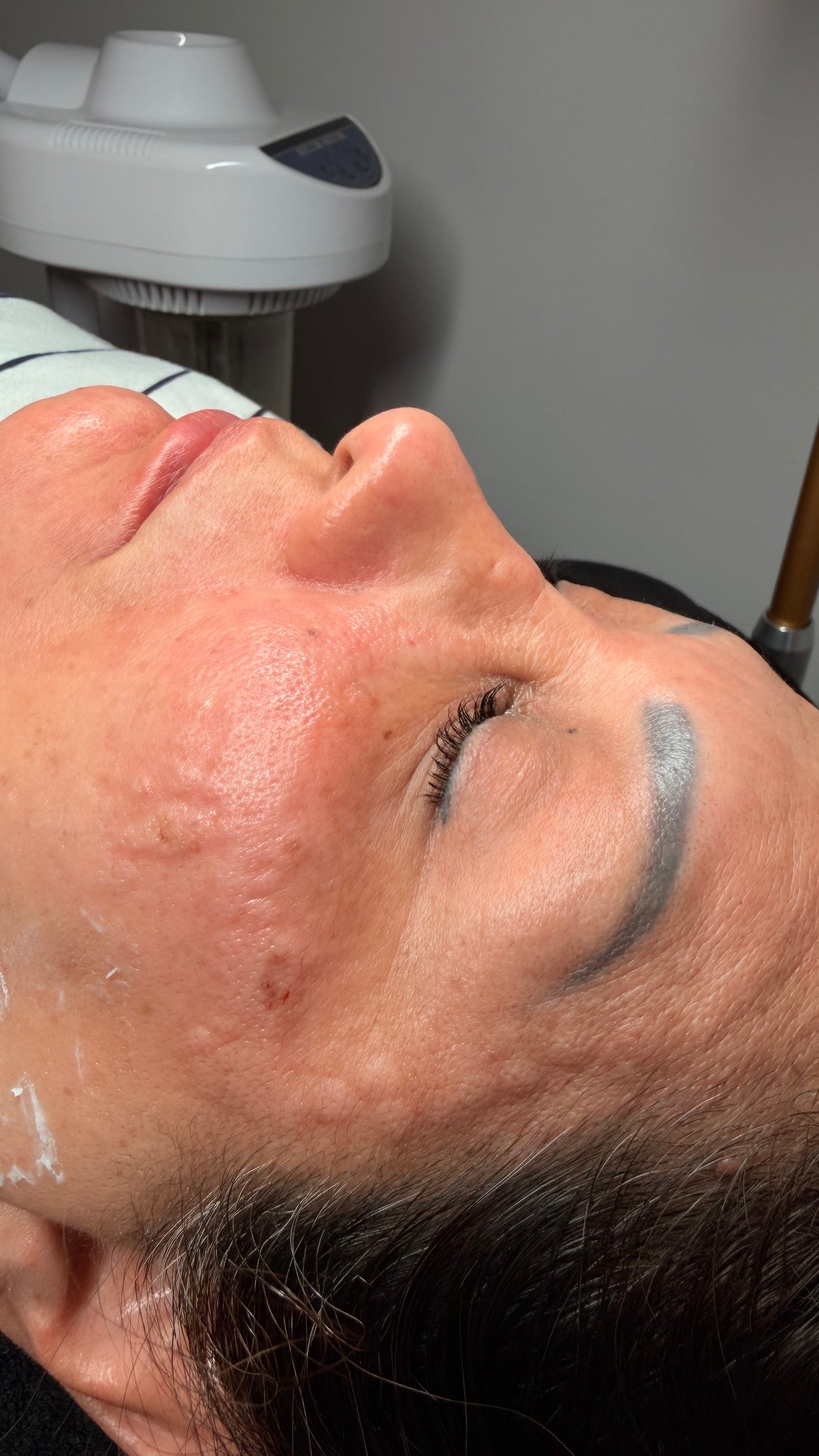 Mesoterapia
