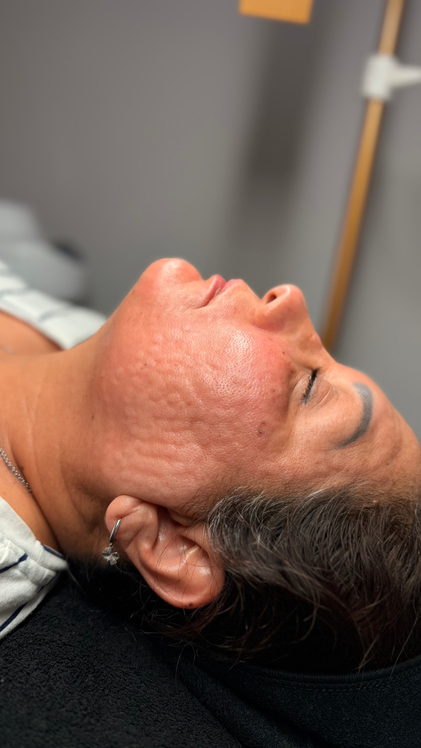 Mesoterapia