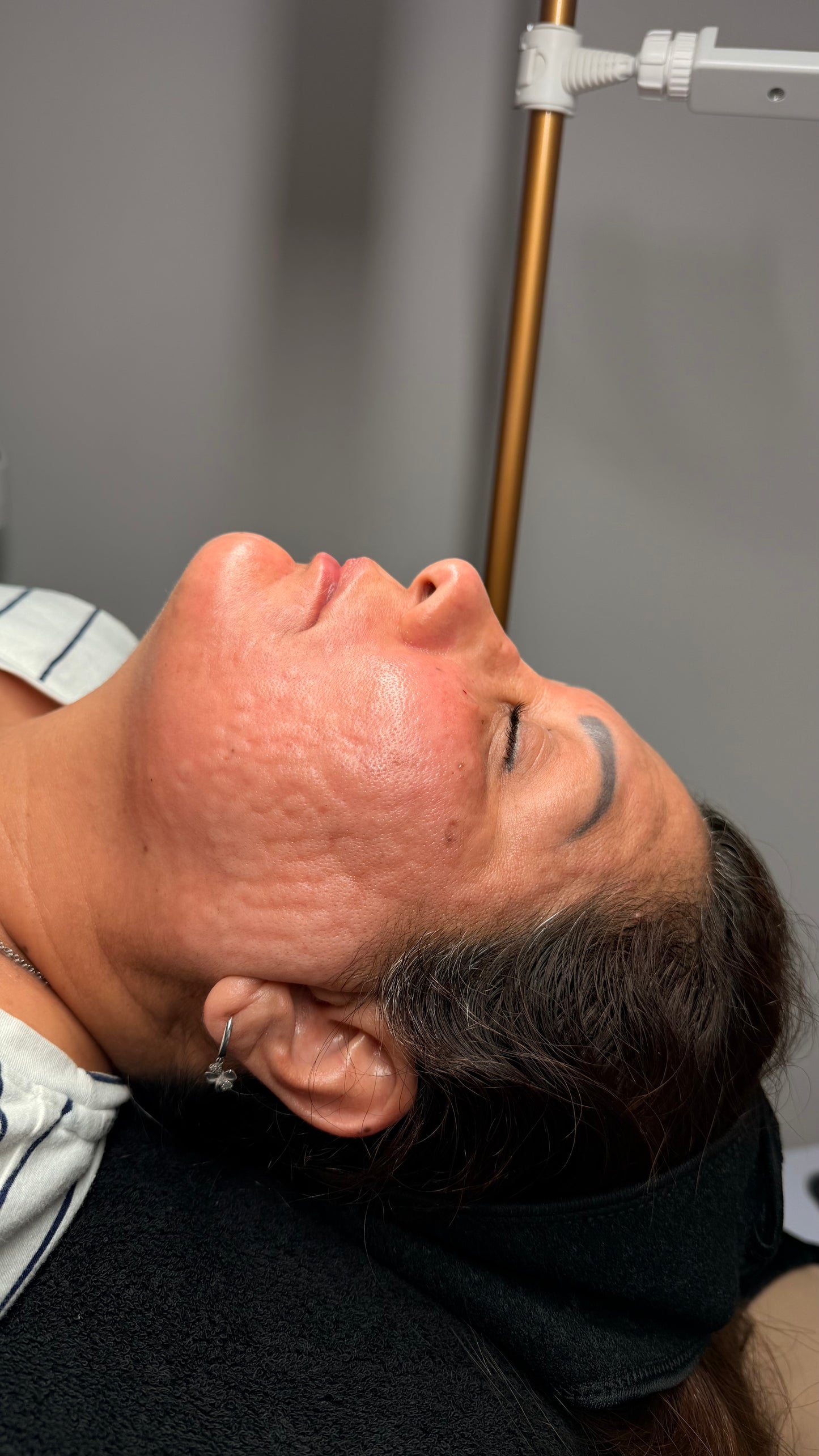 Mesoterapia
