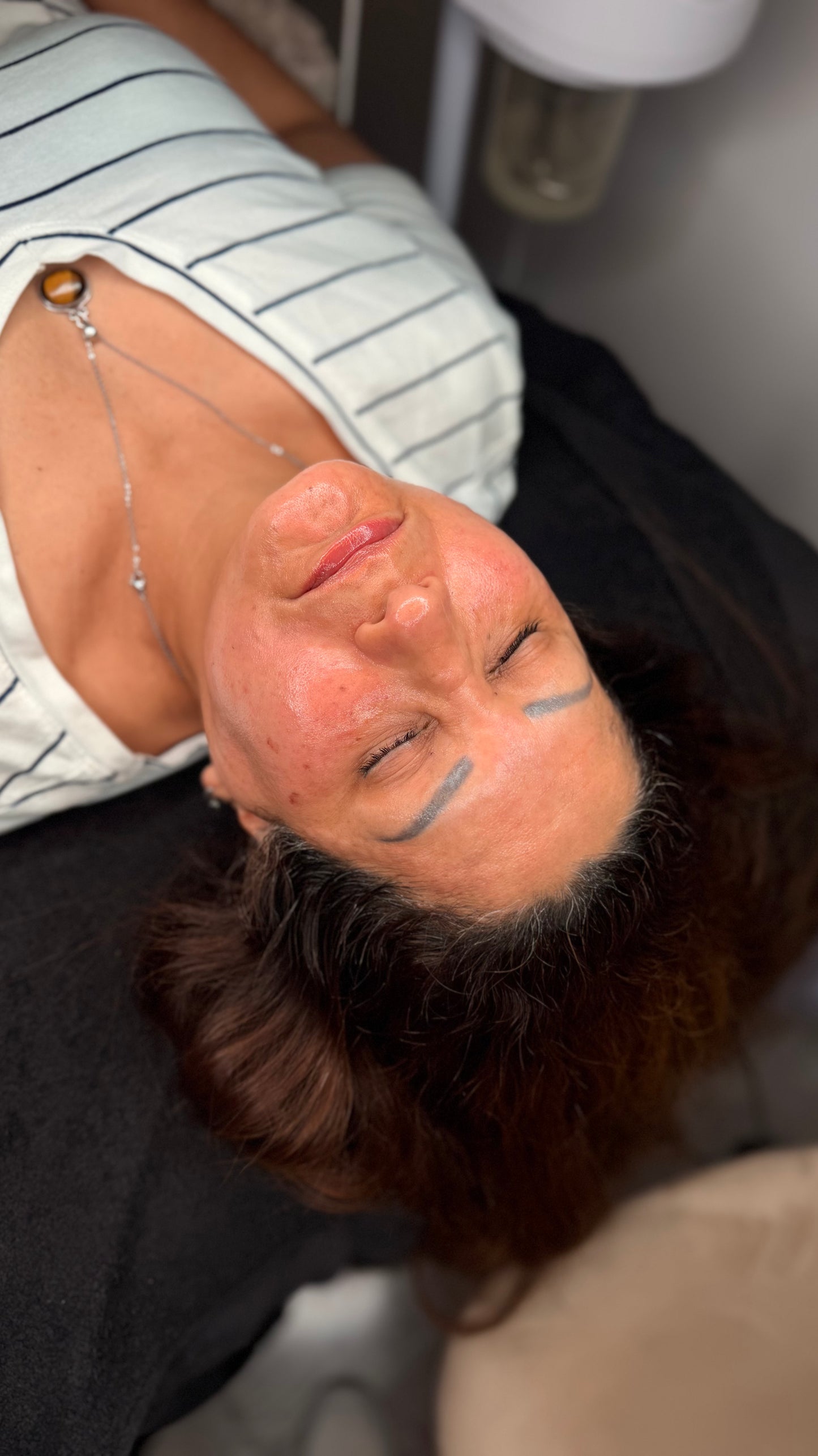 Mesoterapia