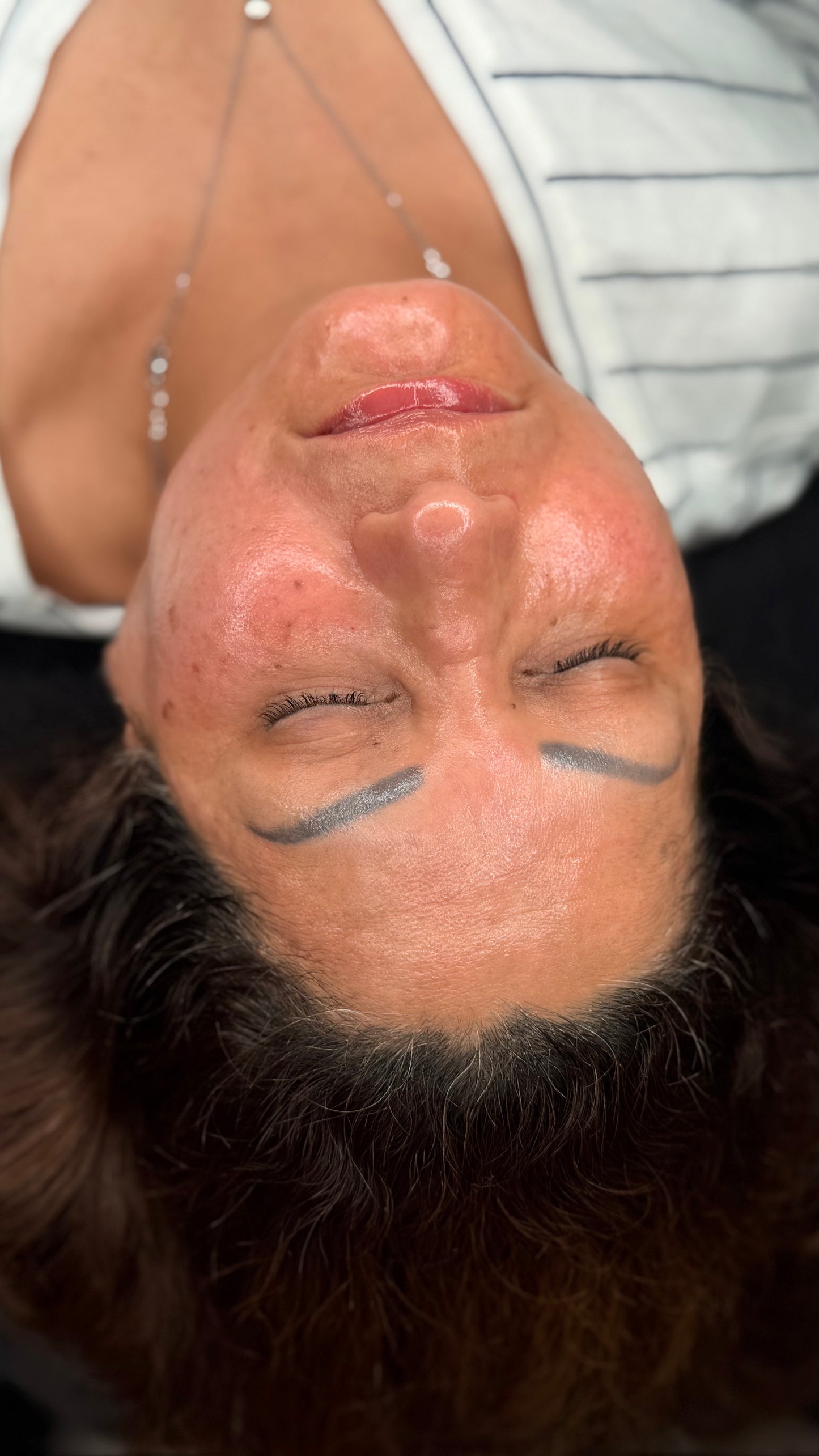 Mesoterapia