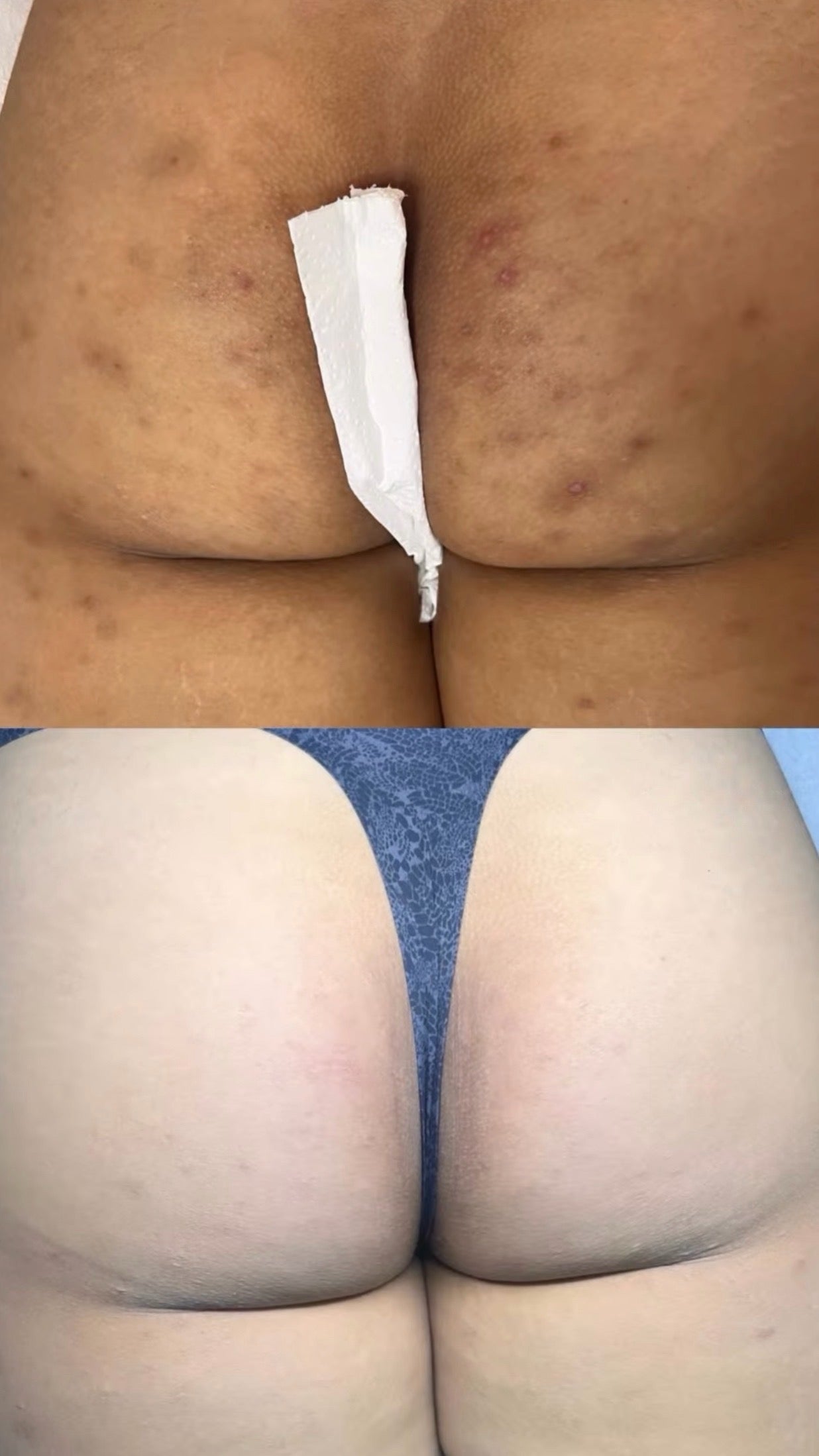 Peeling Natural