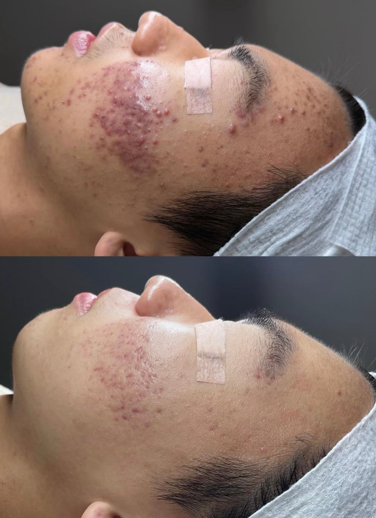 Peeling Natural