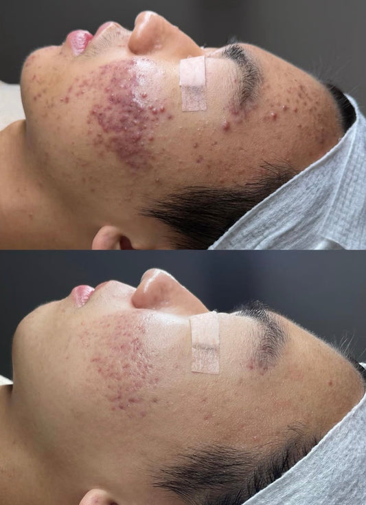 Peeling Natural