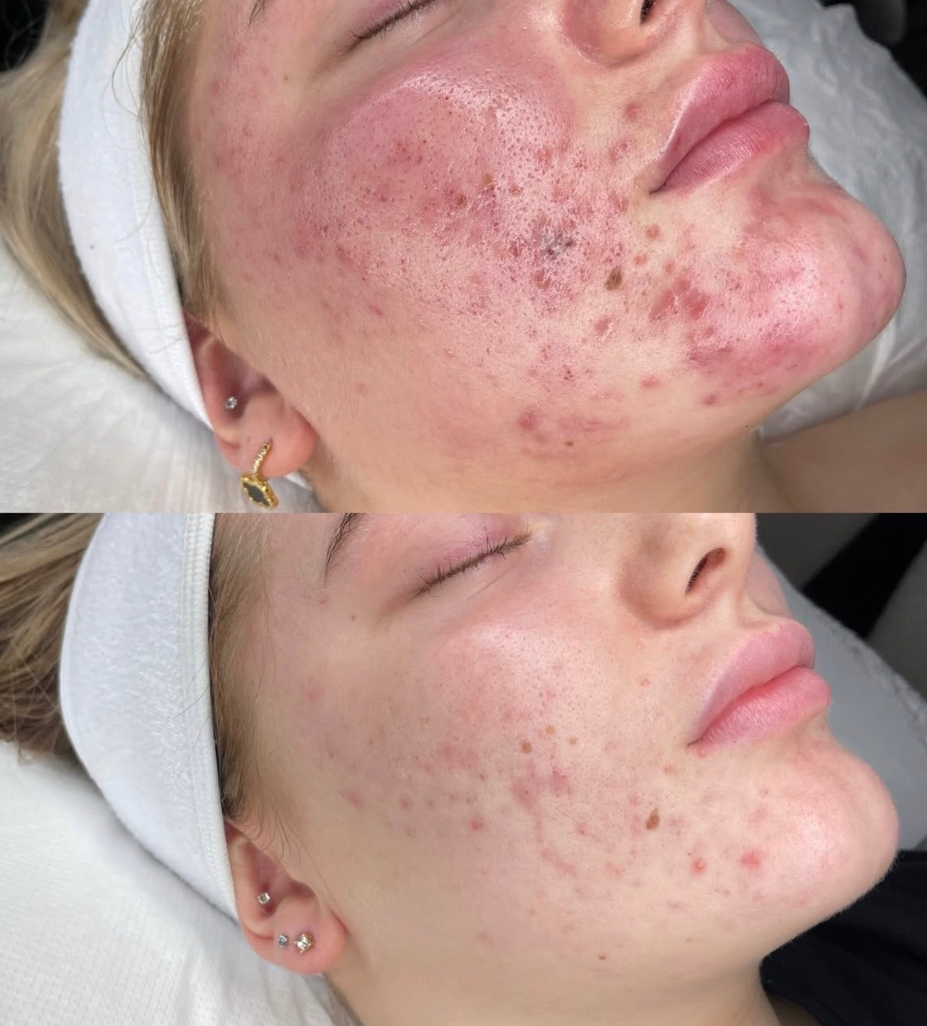Peeling Natural