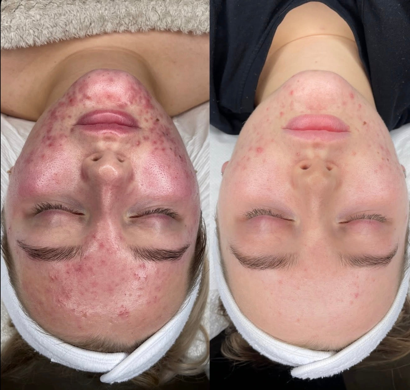 Peeling Natural