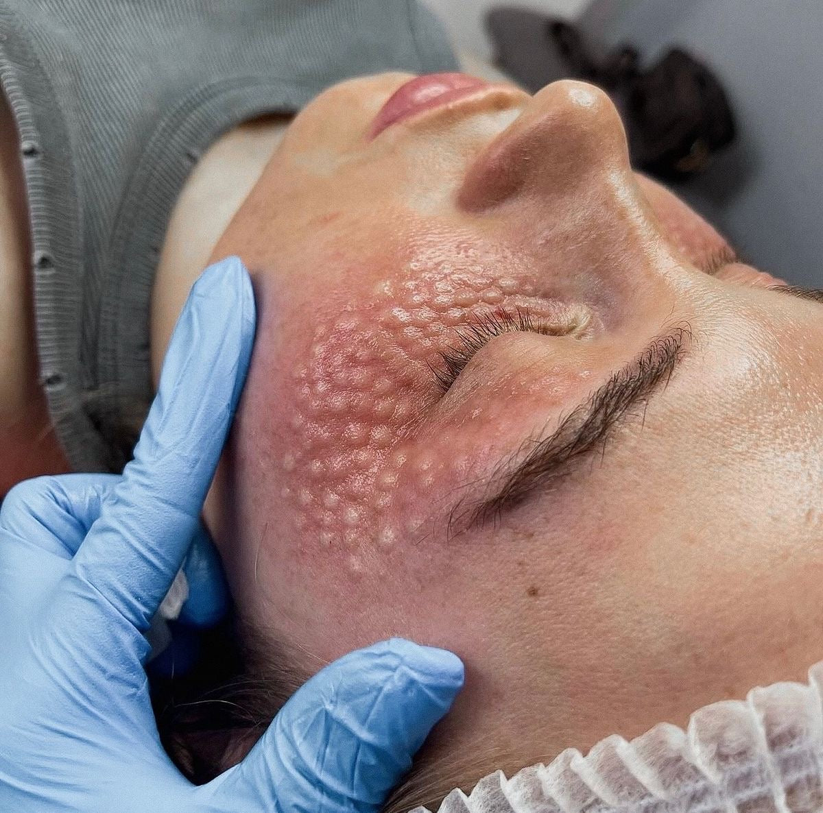 Mesoterapia