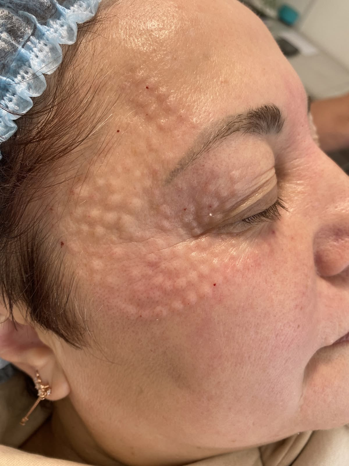 Mesoterapia