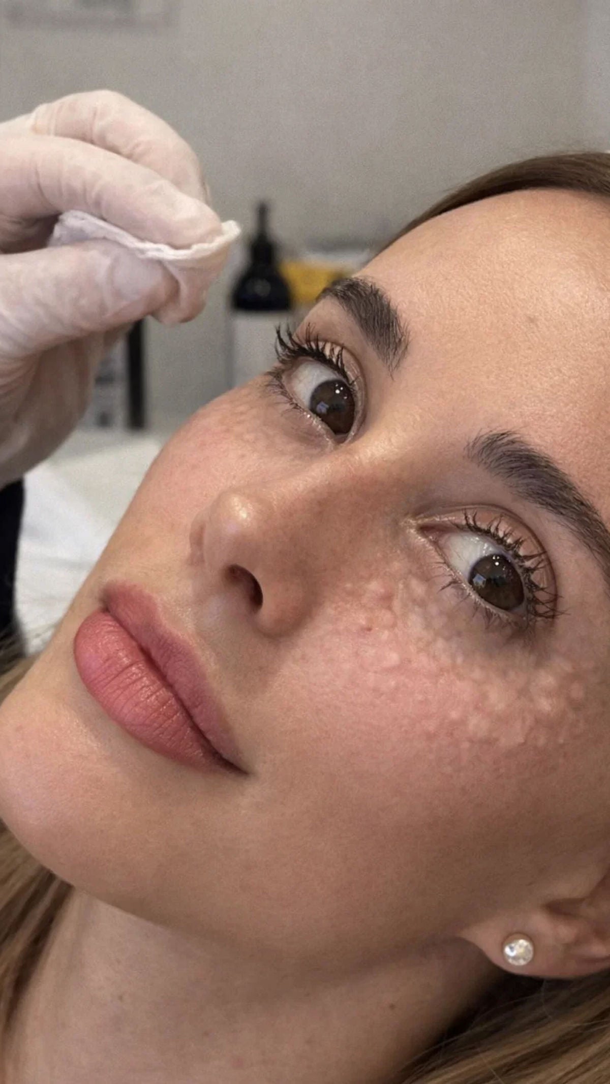 Mesoterapia