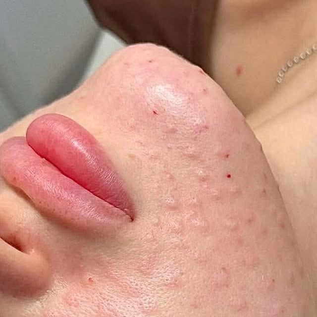 Mesoterapia